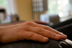 Acupuncture needle in hand